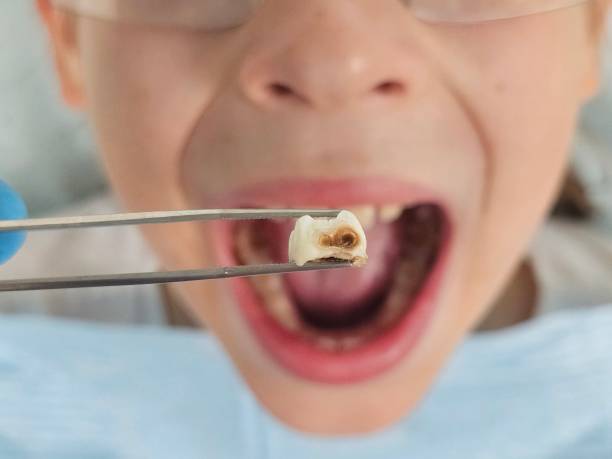 Best Emergency Wisdom Teeth Removal in Lawnside, NJ